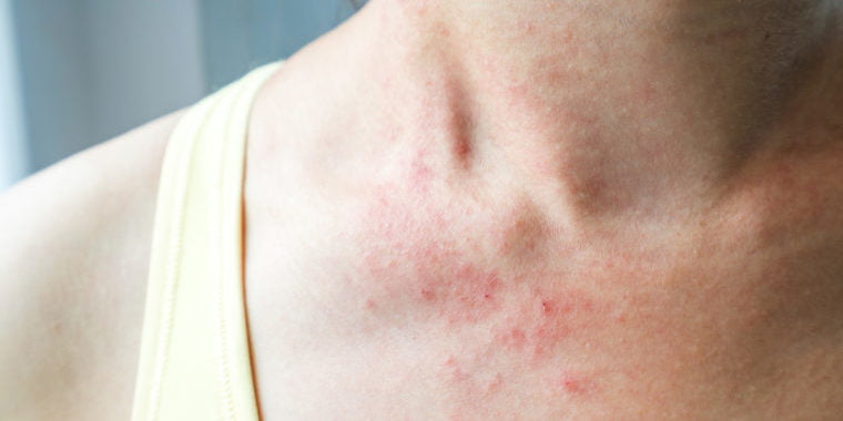 What is the main cause of eczema