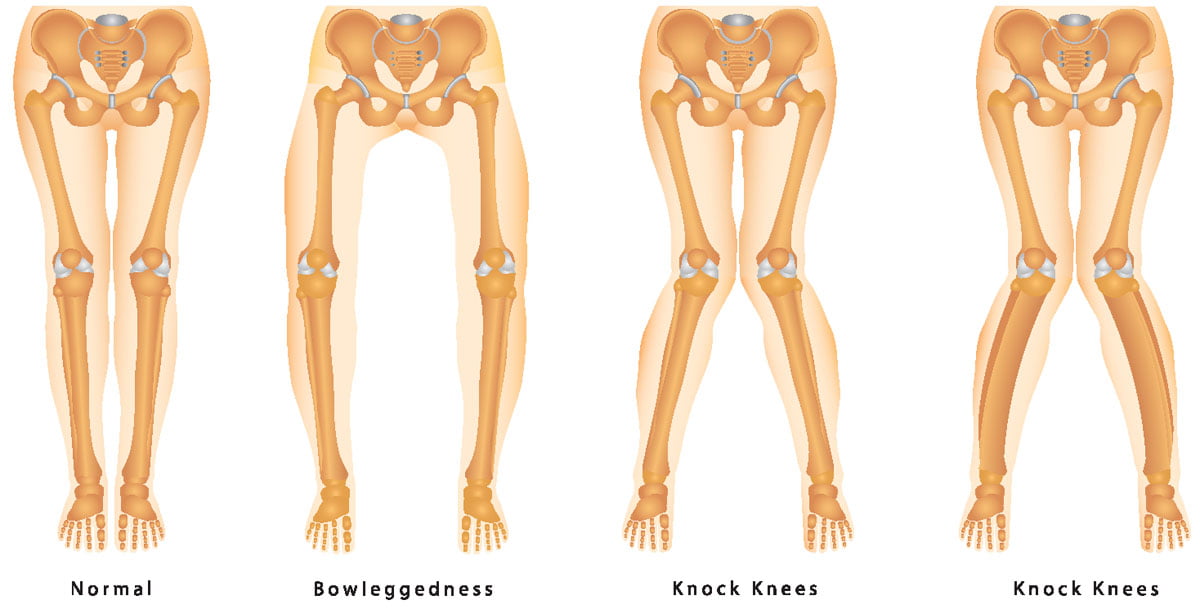 Knock Knees Angular Deformity Of Knee Surgical Program Cubaheal