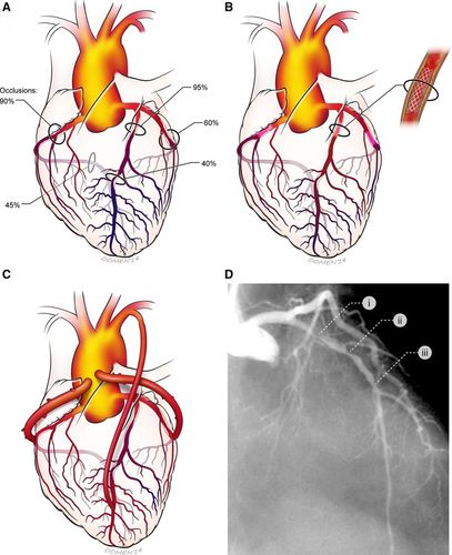 SURGICAL CORONARY REVASCULARIZATION