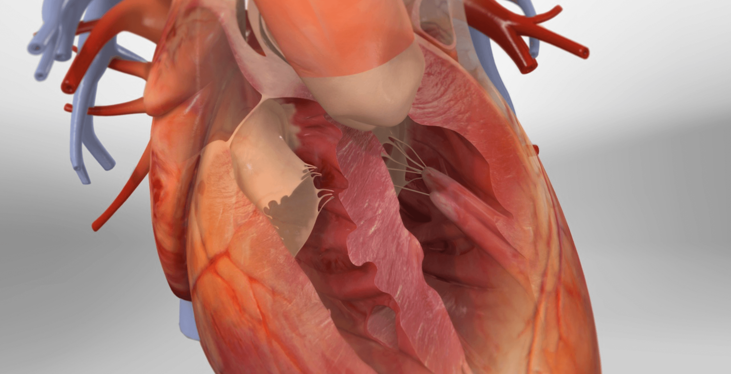 Tetralogy of Fallot